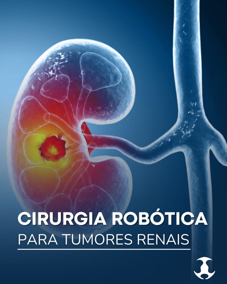 Cirurgia robótica para tumores renais
