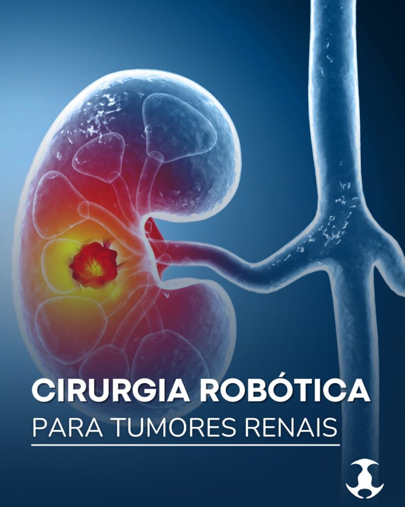 Cirurgia robótica para tumores renais
