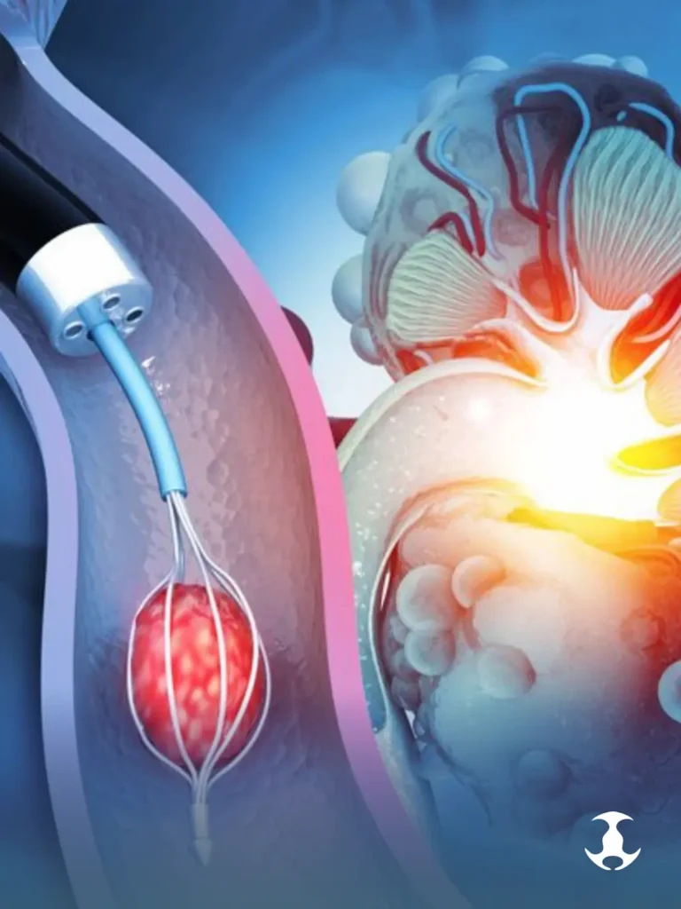 Cirurgia para cálculo renal: hoje, na maioria dos casos, não há cortes